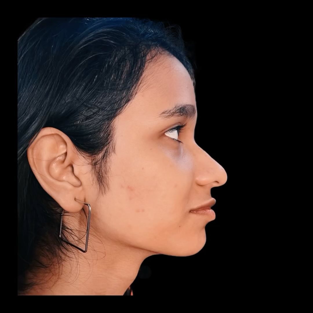 NON SURGICAL JAWLINE ENHANCEMENT WITH poly -L -lactic acid filler